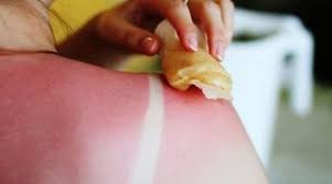 Solnechnye Ozhogi Pervye Simptomy I Pomosh Chto Delat V Domashnih Usloviyah Kakie Mozhno Ispolzovat Kremy I Mazi Narodnye Sredstva