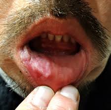 Image result for syphilis ulcer