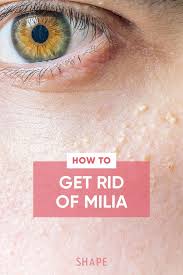 How to get rid of pimple under eye. What Are Those Tiny White Bumps Under Your Eyes Skin Bumps On Face White Bumps On Face Skin Bumps