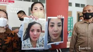 Nindy ayunda tak pernah dalam gugatan, nindy menyinggung masalah perbedaan pendapat serta kurangnya perhatian dari. Deretan Foto Bukti Kdrt Nindy Ayunda Luka Lebam Hingga Rambut Rontok Foto 1