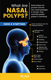 Nasal polyps may be treated with both surgical and medical therapies. 13 Signs You Ve Got A Nasal Polyp Problems And How To Fix It Heal Cavities Sinusitis Natural Remedies