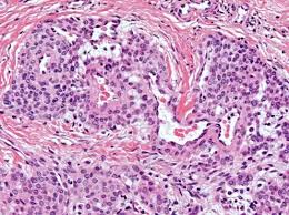 Image result for Glomus tumor