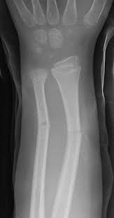 Greenstick Fracture Wikipedia