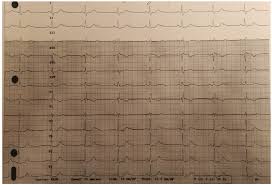 Image result for Atrioventricular Block