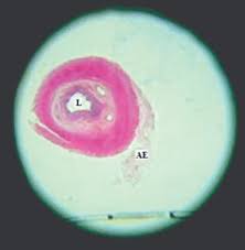 Tables should appear at the end of your paper, after the reference list and before any appendixes. Jcdr Appendices Epiploicae Lymphoid Infiltration Mesentery Torsion