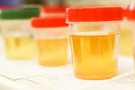 Warna air kencing bervariasi dari jernih hingga kuning tua. Ciri Urine Normal Dari Warna Bau Dan Jumlahnya