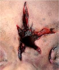 We did not find results for: Pathology Outlines Gunshot Wounds