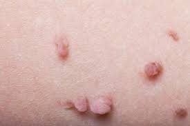 Neurofibromatosis: Types, Causes, And Symptoms