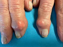 Image result for gout