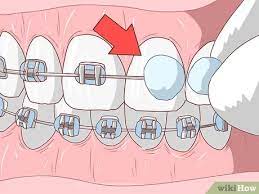 Paul duryea explains how a little bit of wax will stop you getting irritated cheeks and gums when you have first have your metal braces put. How To Avoid Pain When Your Braces Are Tightened 14 Steps