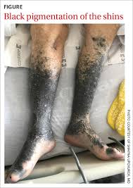 Image result for Pigment stains on the shin