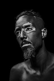 Theo's Story — Patient Impact