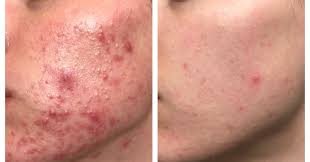 Entdecke rezepte, einrichtungsideen, stilinterpretationen und andere ideen zum ausprobieren. The Exact Skincare Products That Helped Clear This Woman S Cystic Acne In Just 3 Months Cystic Acne Back Acne Treatment Diy Acne Treatment