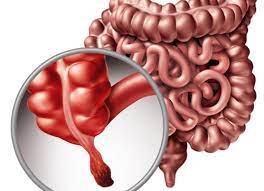A complete guide on gaining weight with a fast metabolism. Appendicitis Facts Causes Symptoms Complications Treatment Factdr