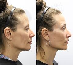 9 month follow up Mini deep plane lower face and neck lift/lower  blepharoplasty/fat transfer/lip lift Few points here. First and foremost  surgery provides more natural results than a bunch of filler. Why?