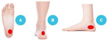 We often stress our minds with constant worries. Heel Pain Online Assessment Modpod Sports Podiatry