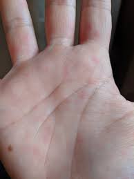 Anyone who has contact with kids or with others who have the disease is susceptible. Mom Vs Hand Foot And Mouth Disease