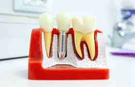 5 Signs You May Be Ready for Dental Implants