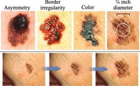 Other features to look out for. What Are Skin Cancer Signs And Symptoms What Does Melanoma Look Like And Is It Caused By Sunburn