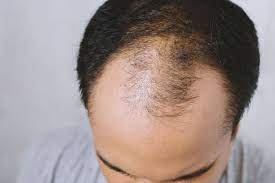 Misinformation leads to stigma and exclusion, which is unfortunate, considering that by age 40, 40% of women will deal with hair loss to some. Medication That Causes Hair Loss Manhattan Nyc True Dorin Medical Group