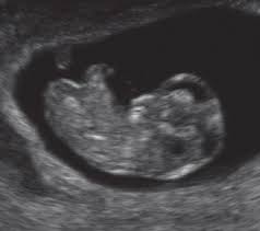 Hallo, bin jetzt in der 17.ssw, ab wann sieht man das geschlecht ??? 10 Anzeichen Die Angeblich Babys Geschlecht Verraten