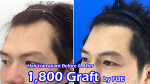 Compare prices, costs & reviews for hair transplant in japan. Fue Hair Transplant For Asian Nobleline Asian Hair Transplant Clinic Youtube