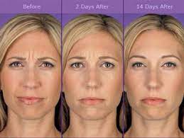 So, whether you're considering the procedure yourself or just curious about its many medical (and cosmetic) effects, here's everything you need to know about botox. Botox Cosmetic Anti Aging Treatments Boston Plastic Surgery
