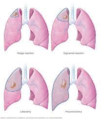 But catching physical warning signs and traces of cancer early on increases your likelihood of survival. Lung Cancer Diagnosis And Treatment Mayo Clinic
