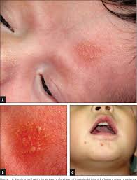 Newborn rash types & treatment подробнее. Pdf Diagnostic Dilemmas Of A Herpes Like Rash In Healthy Neonates Semantic Scholar