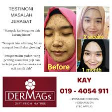 Ubat farmasi untuk jerawat pasir. Ubat Jeragat Di Farmasi Malaysia Jurupulih N
