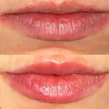 But now that you know how to reduce swelling after lip injections, you'll have far less discomfort. I Tried Lip Injections Here S What To Expect Before And After