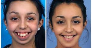 قبل وبعد عمليات تقويم الاسنان شاهد كيف أصبح شكلهم الآن Https Youtu Be Xdjmyzhj1z0 Reconstructive Surgery Orthognathic Surgery Plastic Surgery