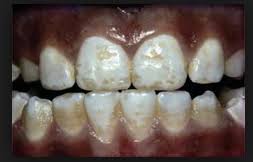 Image result for Fluoride Toxicity