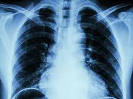 Pleural plaques are the most common consequences of asbestos exposure. Pleural Plaques Sufferers Entitled To Compensation