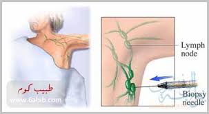 علاج التهاب الغدد اللمفاوية تحت الابط اجمل بنات