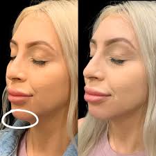 Filler treatment to the nose, chin and jaw to gently soften, lift and  define #restylane #voluma #rejuvenation #nose #bestDAYever #drsorisday #nyc