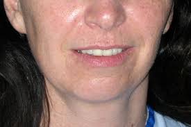 Cheek & Chin Implants Photos