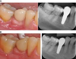 Zirconia Dental Implants Where Are We Now And Where Are We