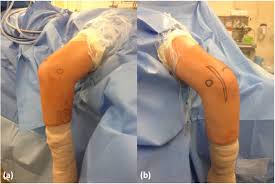 Shingles recovery stages can span anywhere from 3 weeks to several months, depending on complications from shingles. Loose Bodies Of The Elbow Joint Cancer Therapy Advisor