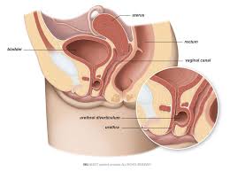 Finding the urethra and avoiding utis are two common problems encountered by female catheter users. Primary Urethral Cancer Patient Information
