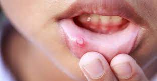 How To Remove Tartar Buildup On Teeth Mouth Ulcer Home Remedy Canker Sore Mouth Ulcers