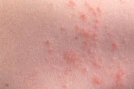 Image result for sweat rash on back baby