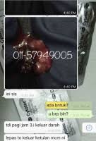 Spog dengan metode vakum aspirasi menggunakan alat medis steril. Klinik Pembekal Ubat Gugur Kandungan Malaysia 0168683038 Mtp Kit Ubat Gugur Pil Gugur Cytotec Cytolog Malaysialistings