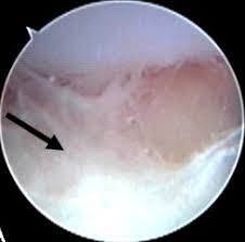 Image result for Septic Joint