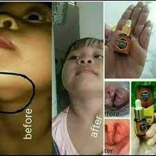 Jerawat di dagu bisa jadi tanda tubuh sedang mengalami perubahan hormon. Facebook