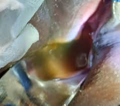 Image result for Vaginal Pooling