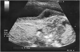 Nuchal translucency (nt) measurement nuchal translucensy (nt) is the clear space in the tissue of your developing baby's neck. Pregnancy Outcome In Fetuses With Increased Nuchal Translucency Journal Of Perinatology