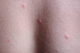 In most circumstances, spiders do not bite humans. Identifying Common Summer Bug Bites
