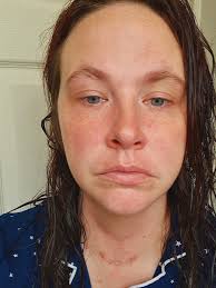 Has anyone been started