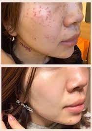 美白効果 2万8千円で顔全体のほくろ シミ取りに行ってみた 衣の美容日記 フェイスケア 顔 シミ 消す 美白